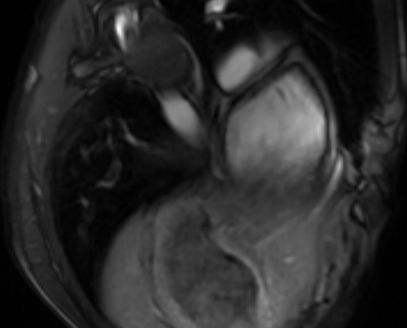 Arrhythmogenic right ventricular cardiomyopathy (Radiopaedia 69564-79464 4ch cine 153).jpg