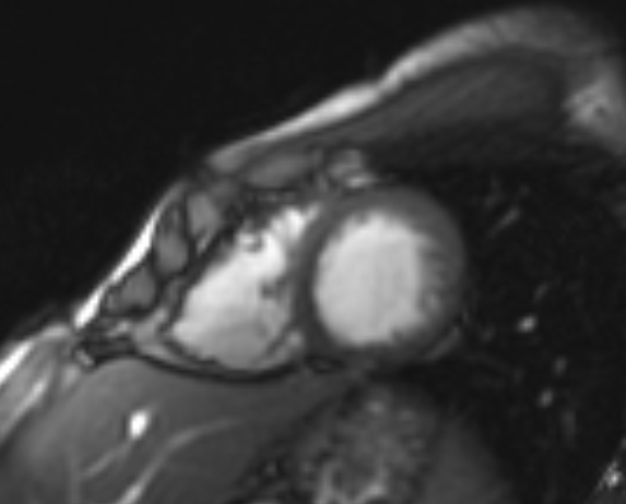 Arrhythmogenic right ventricular cardiomyopathy (Radiopaedia 69564-79464 short axis cine 62).jpg