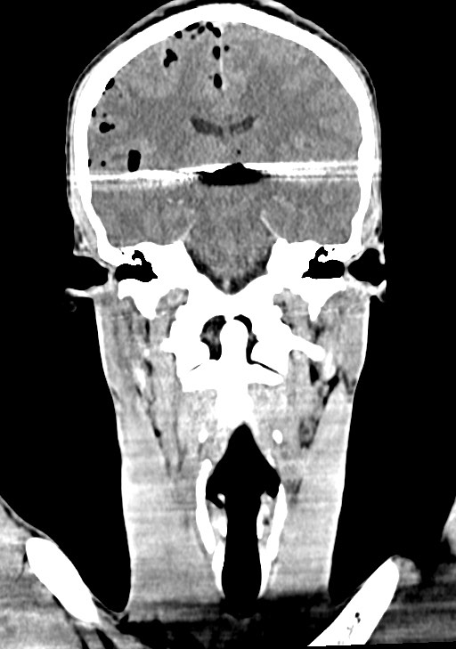 Arrow injury to the brain (Radiopaedia 72101-82607 Coronal non-contrast 43).jpg