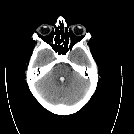 File:Arteriovenous malformation (cerebral) (Radiopaedia 40070-42579 Coronal non-contrast 1).png