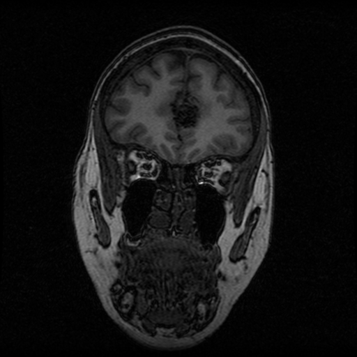 Arteriovenous malformation (cerebral) (Radiopaedia 40070-42580 Coronal T1 48).png