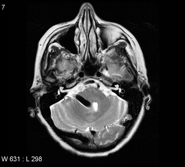 File:Arteriovenous malformation - cerebral (Radiopaedia 4000-6538 Axial T2 1).jpg
