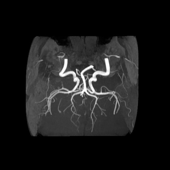 Artery of Percheron infarct (Radiopaedia 40966-43676 F 51).jpg