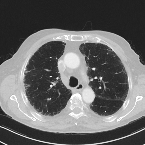 File:Asbestosis (Radiopaedia 56192-62864 Axial lung window 24).png