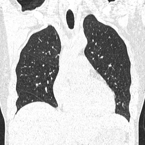 File:Aspergilloma (Radiopaedia 26223-26347 Coronal lung window 18).jpg