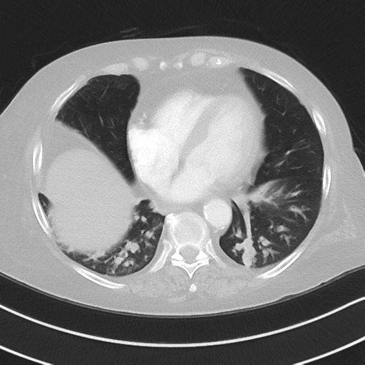 Aspiration bronchiolitis (Radiopaedia 53464-59463 Axial lung window 40).png