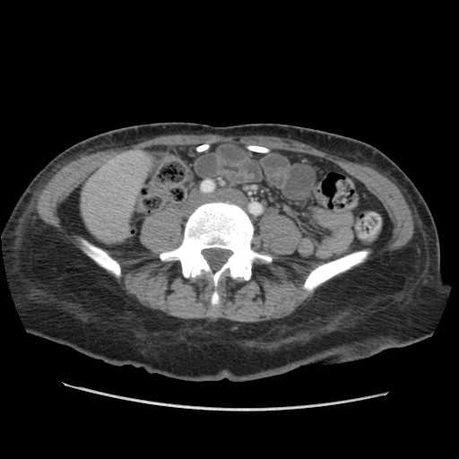 File:Aspiration pneumonia secondary to laparoscopic banding (Radiopaedia 18345-18183 A 79).jpg