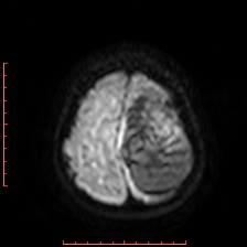 Astroblastoma (Radiopaedia 74287-85162 Axial DWI 92).jpg