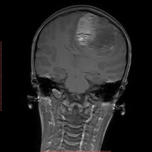 File:Astroblastoma (Radiopaedia 74287-85162 Coronal T1 13).jpg