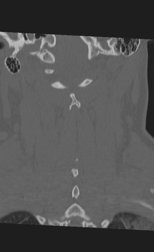 Atlanto-occipital dissociation (Radiopaedia 33848-35013 Coronal bone window 39).png