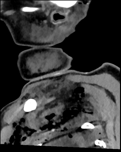 Atlanto-occipital dissociation - Traynelis type 1 (Radiopaedia 87570-103948 D 11).jpg