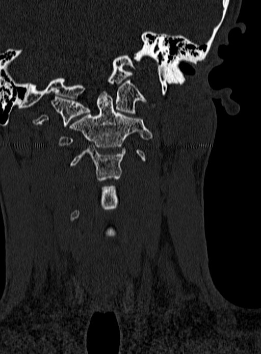 Atlantoaxial subluxation (Radiopaedia 44681-48450 Coronal bone window 27).jpg
