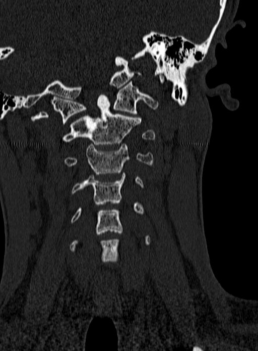Atlantoaxial subluxation (Radiopaedia 44681-48450 Coronal bone window 38).jpg