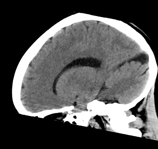 File:Atretic encephalocoele with inferior vermis hypoplasia (Radiopaedia 30443-31107 C 18).jpg