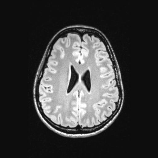 Atretic encephalocoele with inferior vermis hypoplasia (Radiopaedia 30443-31108 Axial 104).jpg