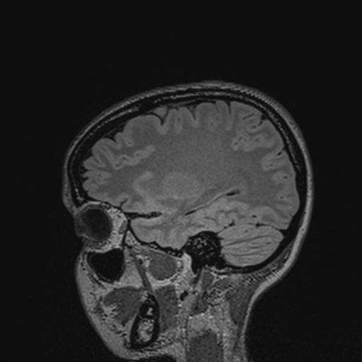 Atretic encephalocoele with inferior vermis hypoplasia (Radiopaedia 30443-31108 Sagittal FLAIR 52).jpg