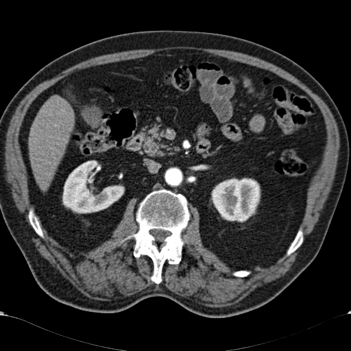 Atypical hepatocellular carcinoma (Radiopaedia 41744-44698 A 45).jpg