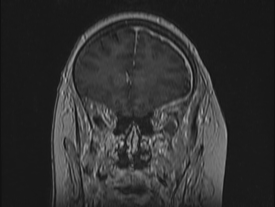 Atypical meningioma (Radiopaedia 62985-71406 Coronal T1 C+ 29).jpg