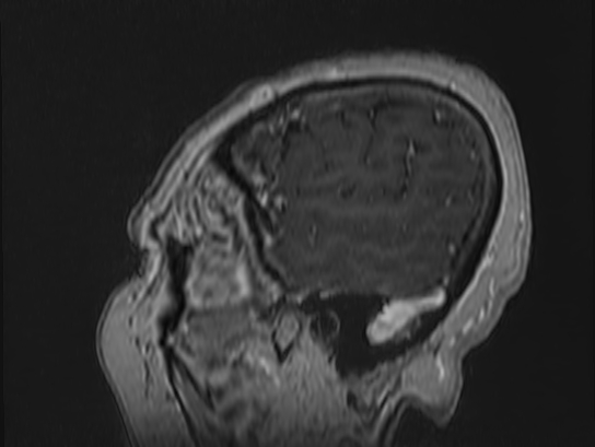 Atypical meningioma (Radiopaedia 62985-71406 Sagittal T1 C+ 6).jpg