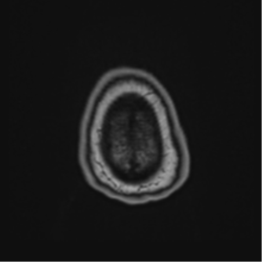 Atypical meningioma (WHO Grade II) (Radiopaedia 54742-60981 Axial T1 69).png