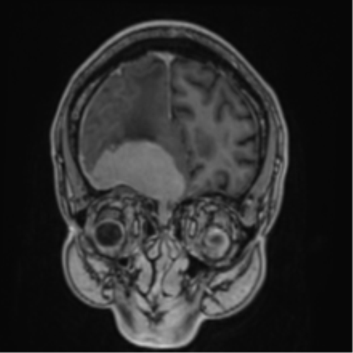 Atypical meningioma (WHO grade II) with brain invasion (Radiopaedia 57767-64729 Coronal T1 C+ 15).png
