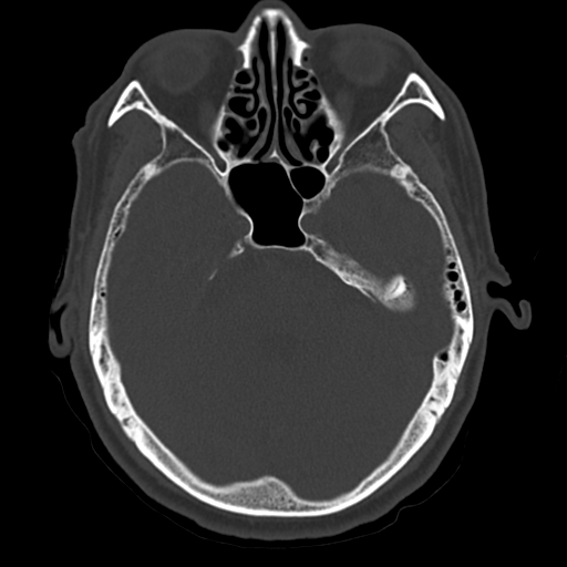 File:Atypical meningioma (WHO grade II) with osseous invasion (Radiopaedia 53654-59715 Axial bone window 26).png