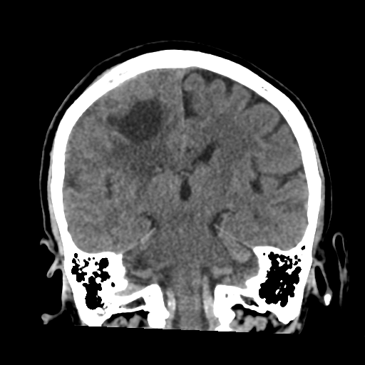 Atypical meningioma (WHO grade II) with osseous invasion (Radiopaedia 53654-59715 Coronal non-contrast 38).png