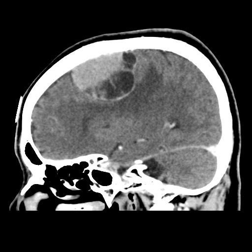 File:Atypical meningioma (WHO grade II) with osseous invasion (Radiopaedia 53654-59715 G 20).png
