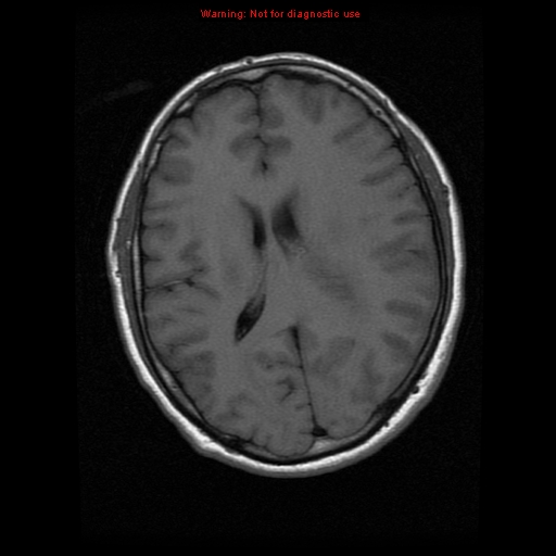 File:Atypical meningioma - grade II (Radiopaedia 13303-13305 Axial T1 13).jpg