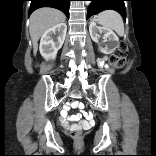 File:Atypical renal cyst (Radiopaedia 17536-17251 C 11).jpg