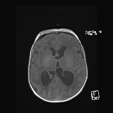 File:Atypical teratoid rhabdoid tumor (prenatal US and neonatal MRI) (Radiopaedia 59091-66388 Axial T1 32).jpg