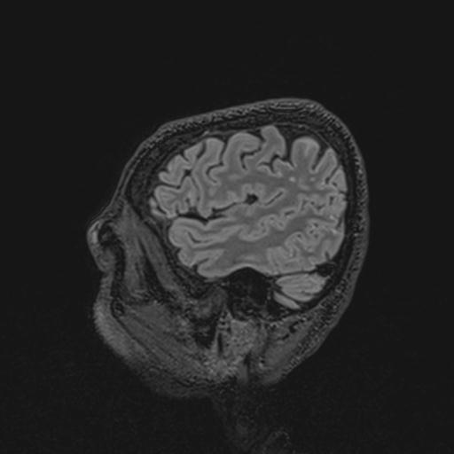 Autoimmune limbic encephalitis (Radiopaedia 30363-31005 Sagittal FLAIR 127).jpg