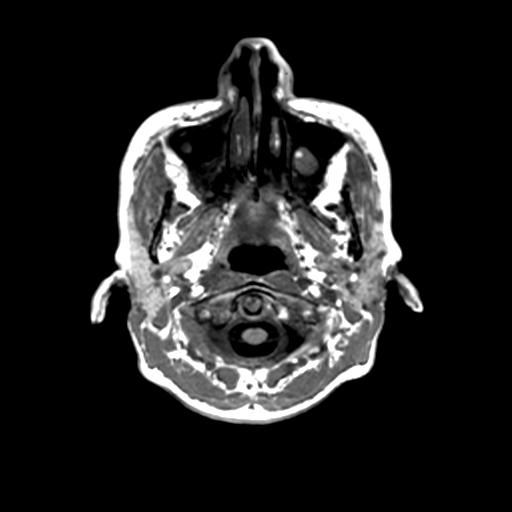 Autoimmune limbic encephalitis (Radiopaedia 30363-31005 T1 Axial 1mm 6).jpg