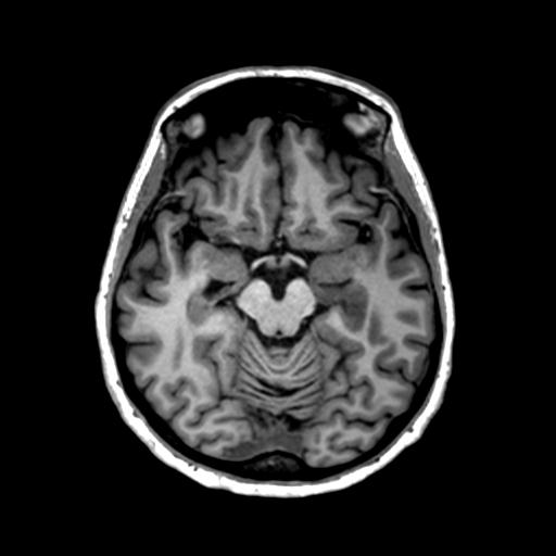 Autoimmune limbic encephalitis (Radiopaedia 30363-31005 T1 Axial 1mm 63).jpg