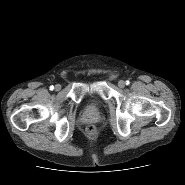 Autosomal dominant polycystic kidney disease (Radiopaedia 27851-28094 B 120).jpg
