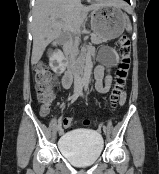 Autosomal dominant polycystic kidney disease (Radiopaedia 38189-40194 Coronal C+ delayed 36).jpg