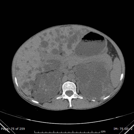 File:Autosomal dominant polycystic kidney disease (Radiopaedia 44122-47684 Axial 41).jpg
