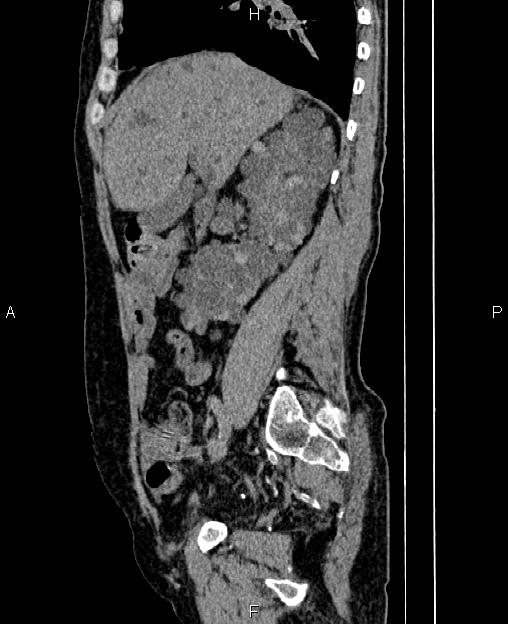 Autosomal dominant polycystic kidney disease (Radiopaedia 87830-104287 C 30).jpg
