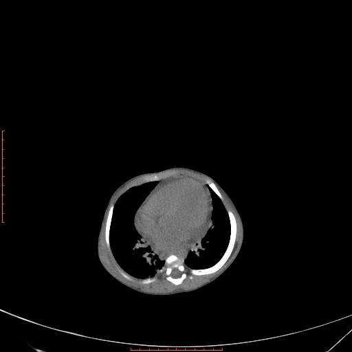 Autosomal recessive polycystic kidney disease associated with Caroli disease (Radiopaedia 61932-69984 B 73).jpg