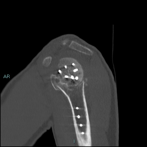 Avascular necrosis after fracture dislocations of the proximal humerus (Radiopaedia 88078-104653 Sagittal bone window 25).jpg