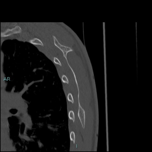 File:Avascular necrosis after fracture dislocations of the proximal humerus (Radiopaedia 88078-104653 Sagittal bone window 78).jpg