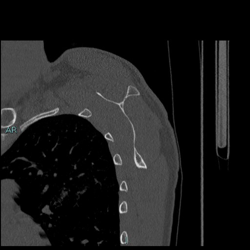 Avascular necrosis after fracture dislocations of the proximal humerus (Radiopaedia 88078-104655 Sagittal bone window 58).jpg