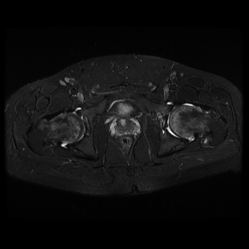 File:Avascular necrosis of the hip (Radiopaedia 61503-69465 Axial STIR 19).jpg