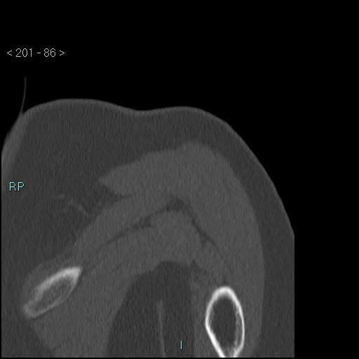 Avascular necrosis of the shoulder - Cruess stage I (Radiopaedia 77674-89887 Coronal bone window 85).jpg