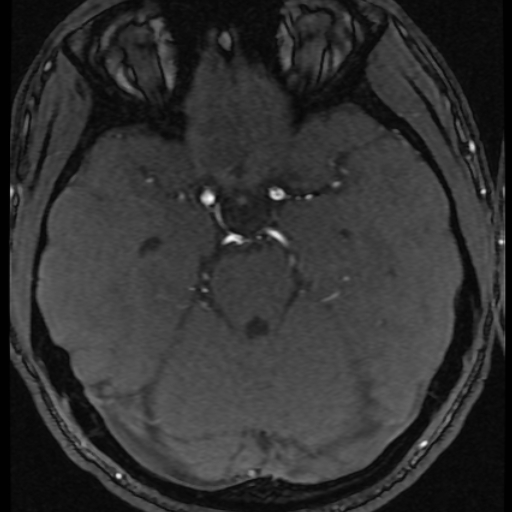 Azygos anterior cerebral artery (Radiopaedia 17059-16756 Axial MRA 47).jpg