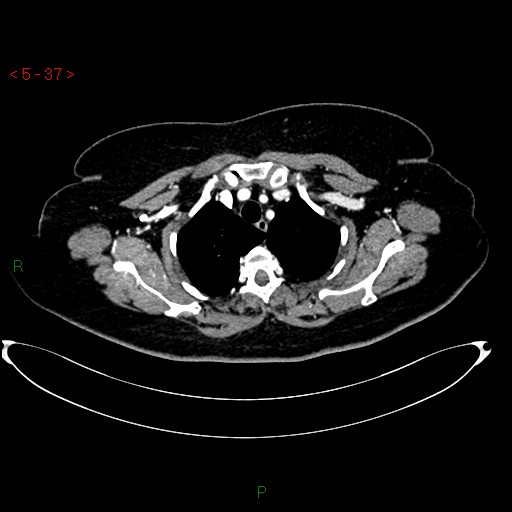 Azygos fissure and lobe (Radiopaedia 47620-52278 A 23).jpg