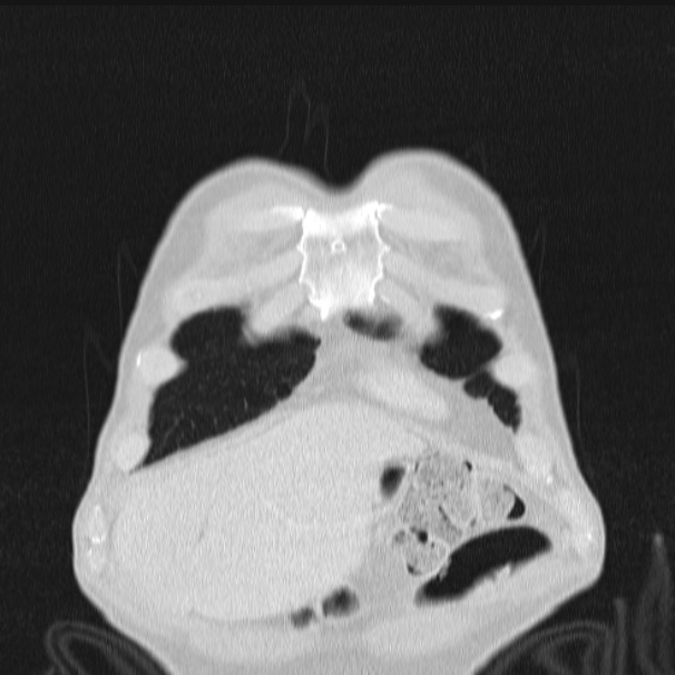 Azygos lobe (Radiopaedia 38259-40275 Coronal lung window 10).jpg