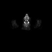 B-cell lymphoma of the mesentery (Radiopaedia 65743-74868 18F-FDG PET-CT 253).jpg