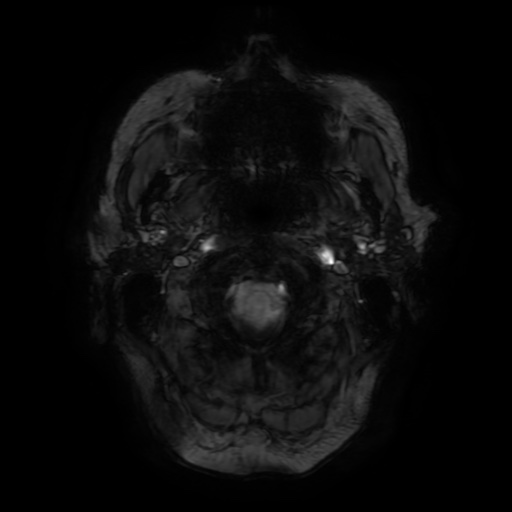 File:Balo concentric sclerosis (Radiopaedia 53875-59982 Axial 3D SWAN 3).jpg