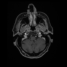 Balo concentric sclerosis (Radiopaedia 53875-59982 Axial LAVA C+ 49).jpg